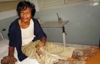 ইন্দোনেশিয়ার বৃক্ষমানব ডেডে আর নেই