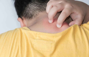 গরমে ঘামাচি থেকে বাঁচার ৭ উপায়