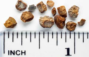 যে ৮টি লক্ষণে বুঝবেন কিডনিতে পাথর জমতে পারে