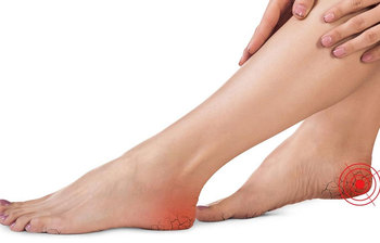 পা ফাটা রোগ সারাতে ১০টি ঘরোয়া উপায় জেনে নিন