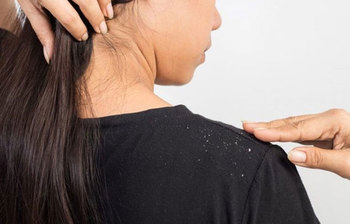 খুসকি থেকে মুক্তির ঘরোয়া ৫টি উপায় জেনে নিন