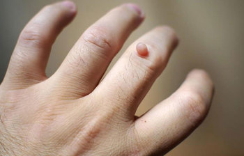 ঘরোয়া উপায়ে খুব সহজে আঁচিল দূর করুন