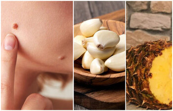 আঁচিল দূর করার সহজ উপায়