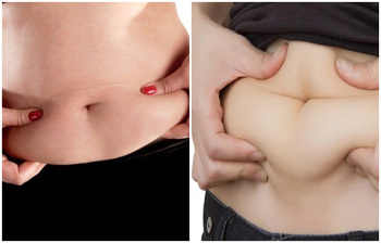 ঘরোয়া উপায়ে ৭ দিনে তলপেটের চর্বি দূর করবেন যেভাবে