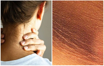 সহজে দূর করুন ঘাড়ের কালো দাগ