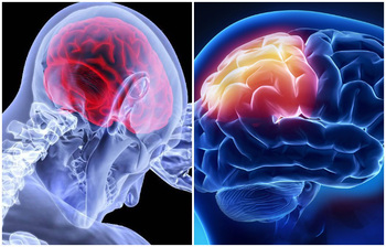 ব্রেন স্ট্রোকের ঝুঁকি কমাতে যা করবেন