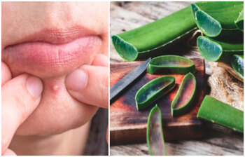 ব্রণ ‌দ্রুত দূর করবেন যেভাবে