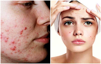পুরোনো ব্রণ থেকে মুক্তি পাওয়ার ঘরোয়া উপায়