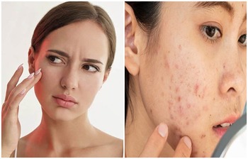 জীবনযাপনে যেসব পরিবর্তনে ব্রণ ‌‌‍দূর হবে