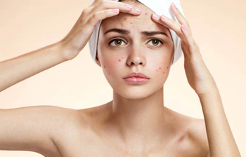 ব্রণ সমস্যা দূর করার সহজ ৫টি ভেষজ পদ্ধতি জেনে নিন