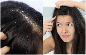 শীতে ঘরোয়া উপায়ে খুশকি দূর করবেন যেভাবে