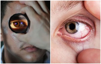 যেসব কারণে চোখে ছানি পড়তে পারে