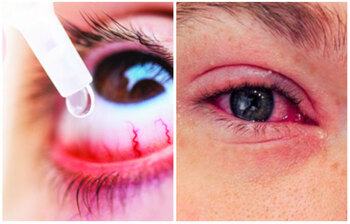 চোখ ওঠার কারণ ও প্রতিকার