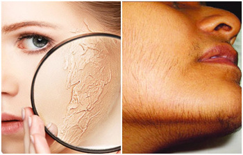 ঘরোয়া উপায়ে দূর করুন মুখের অতিরিক্ত লোম