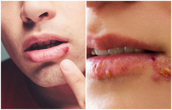 জ্বরে মুখে ঘা হলে যে ৫ ঘরোয়া উপায়ে চিকিৎসা করবেন