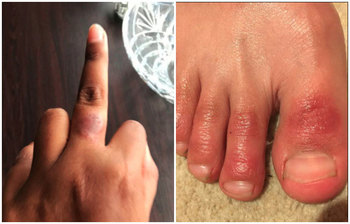 হাত পায়ের আঙুলে বা পাতায় র‌্যাশ নিয়ে যে তথ্য দিলেন বিজ্ঞানীরা