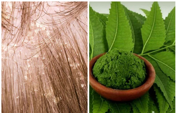 বর্ষায় খুশকি দূর করার সহজ উপায়