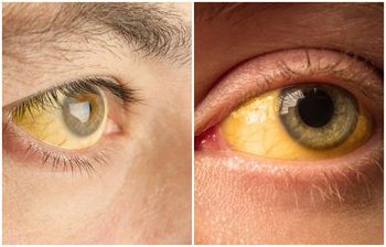 জন্ডিস থেকে দ্রুত সুস্থ হতে যেসব খাবার খাবেন