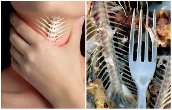 গলায় মাছের কাঁটা আটকে গেলে কী করবেন?