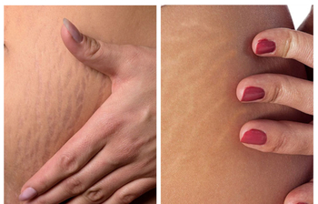 সহজেই দূর করুন স্ট্রেচ মার্কস