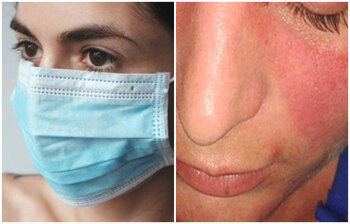 মাস্কে র‌্যাশের সমস্যা হলে সহজে সমাধান করবেন যেভাবে