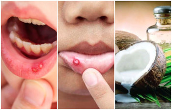 মুখের ঘা দূর করতে সহজ ৫ কার্যকরী উপায়