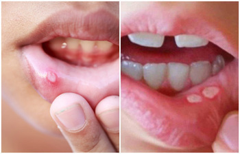 মুখে আলসারের ক্ষত ঘরোয়া উপায়ে দূর করবেন যেভাবে