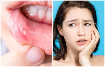 যেসব কারণে মুখে আলসার হয়