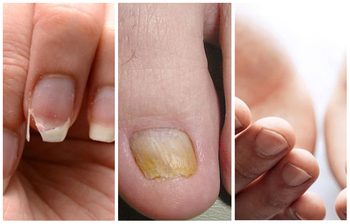 হাত ও নখ দেখে বোঝা যাবে শরীরের কঠিন রোগ