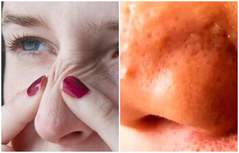 নাকের ব্ল্যাকহেডস দূর করুন ঘরোয়া উপায়ে