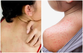 গরমে ঘামাচির সমস্যা থেকে বাঁচার সহজ উপায়