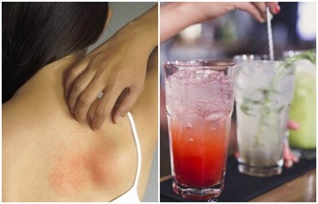 গরমে ঘামাচি থেকে সহজেই দূরে থাকুন