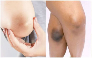 সহজে দূর করুন হাঁটু-কনুই-গোড়ালির কালো দাগ