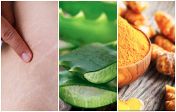 ঘরে বসে স্ট্রেচের দাগ দূর করবেন যেভাবে