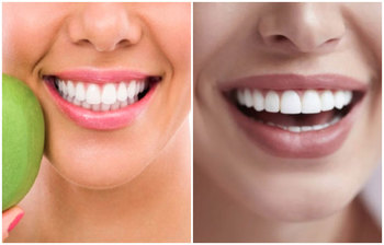 সহজ উপায়ে দাঁতের কালো ছোপ দূর করার উপায়