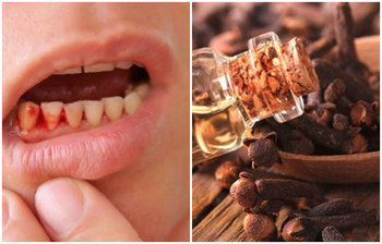 সহজ উপায়ে মাড়ি থেকে রক্ত পড়া দূর করুন