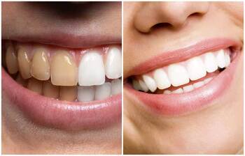 দাঁতের কালচে দাগ দূর করার ঘরোয়া উপায়