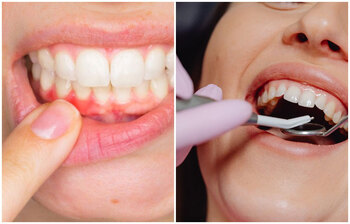 মাড়ি সুস্থ রাখতে যা করবেন