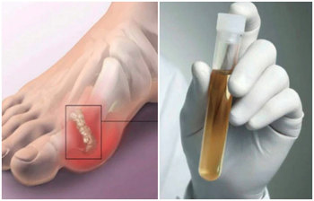 রক্তে মারাত্মক ক্ষতিকর ইউরিক অ্যাসিড নিয়ন্ত্রণে যা করবেন