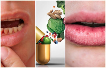 যেসব লক্ষণে বোঝা যাবে শরীরে ভিটামিনের অভাব আছে