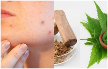 ব্রণ সমস্যা সারাতে সেরা ৫টি ভেষজ উপায়