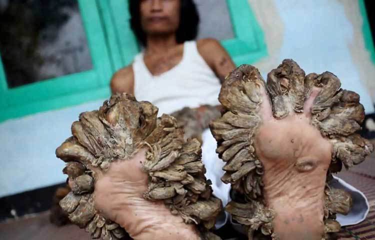 বৃক্ষমানব ডেডে কসওয়ারার মন্ত্রণাময় জীবন।