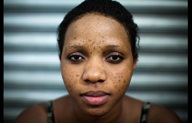 মুখে ব্রণের কারণে দুশ্চিন্তায় পড়েছেন উগান্ডার ১৬ বছরের এক তরুণী। ছবি : সিএনএন