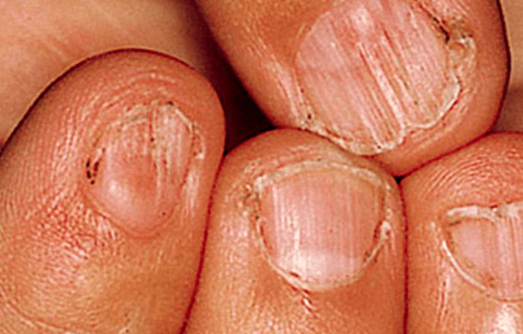 বয়স্ক মানুষদের মধ্যে দেখা যায় ফাটা নখ। এটি থাইরয়েডের একটি লক্ষণ হতে পারে। নখের রঙ হলুদ হলে ধরে নিতে হবে কোনো ফাংগাল ইনফেকশন রয়েছে।