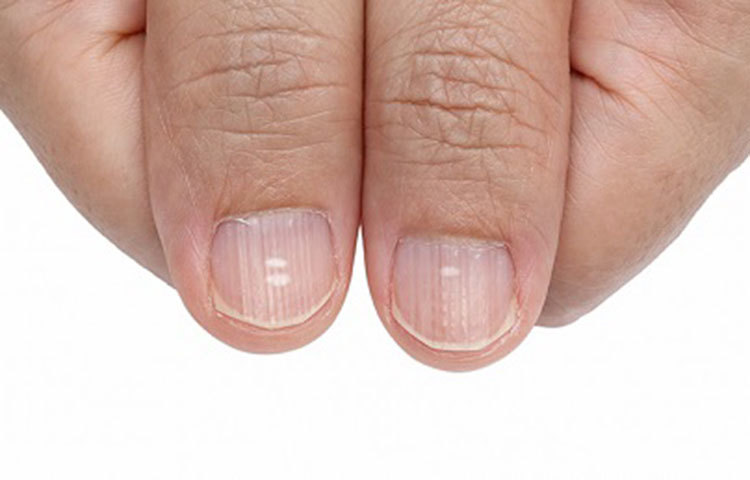 নখের ওপরে সরু লাইন দেখা গেল তা বাতের পূর্বলক্ষণ হতে পারে। তবে নখের নীচে লালচে বা কফি রঙের হলে তা বাতের নিশ্চিত লক্ষণ।