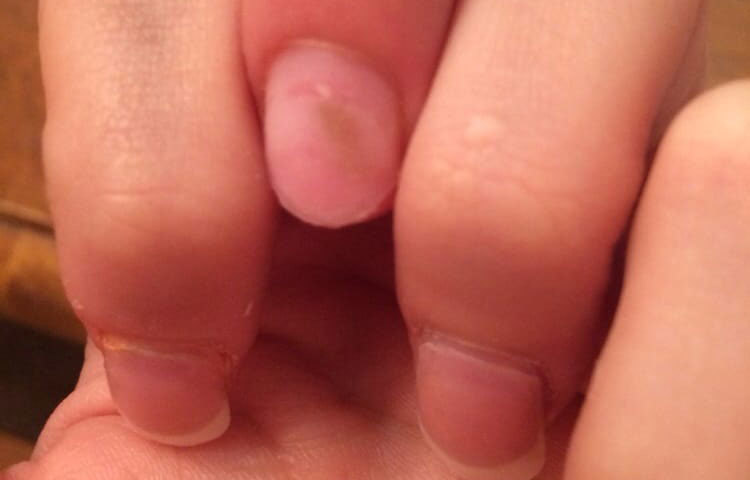 নখের নীচে কালো দাগ হলে তা গুরুত্ব দিয়েই ভাবা উচিত। এটি মেলানোমা বা চামড়ার ক্যান্সারের পূর্ব লক্ষণ হতে পারে।