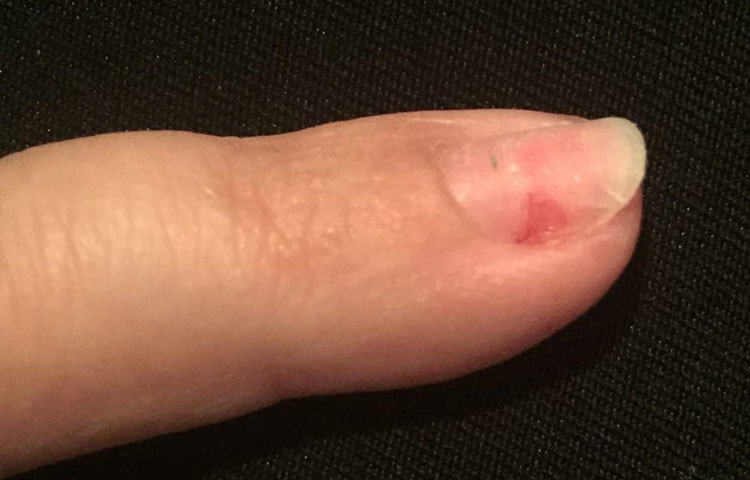 নখের যে অংশের সঙ্গে চামড়ার যোগ থাকে সেখানে লালচে দাগ হলে সাবধান। এটি যক্ষ্মা লক্ষণ হতে পারে।