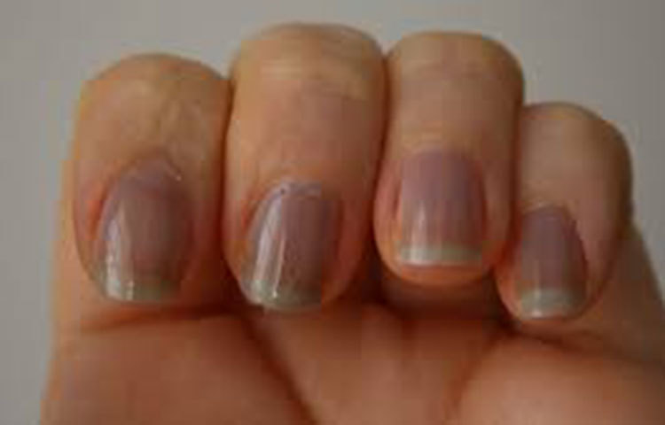 নখ নীলচে হয়ে গেলে সাবধান হতে হবে। ডায়বেটিস বা নিউমোনিয়ারও লক্ষণ হতে পারে।