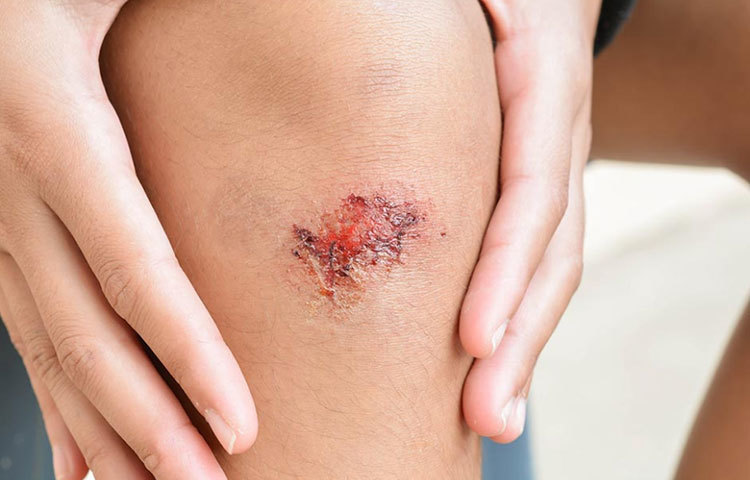 কেটে বা ছিড়ে গেলে যদি শুকোতে সময় লাগে, বুঝতে হবে ডায়াবেটিস হতে পারে।