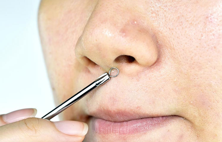 অয়েলি স্কিনে ব্লাক হেডস ও হোয়াইট হেডস হওয়ার প্রবণতা থাকে। নিয়মিত ব্লাকহেডস পরিষ্কার করলে ত্বকের ছিদ্রগুলি খুলে যায়।